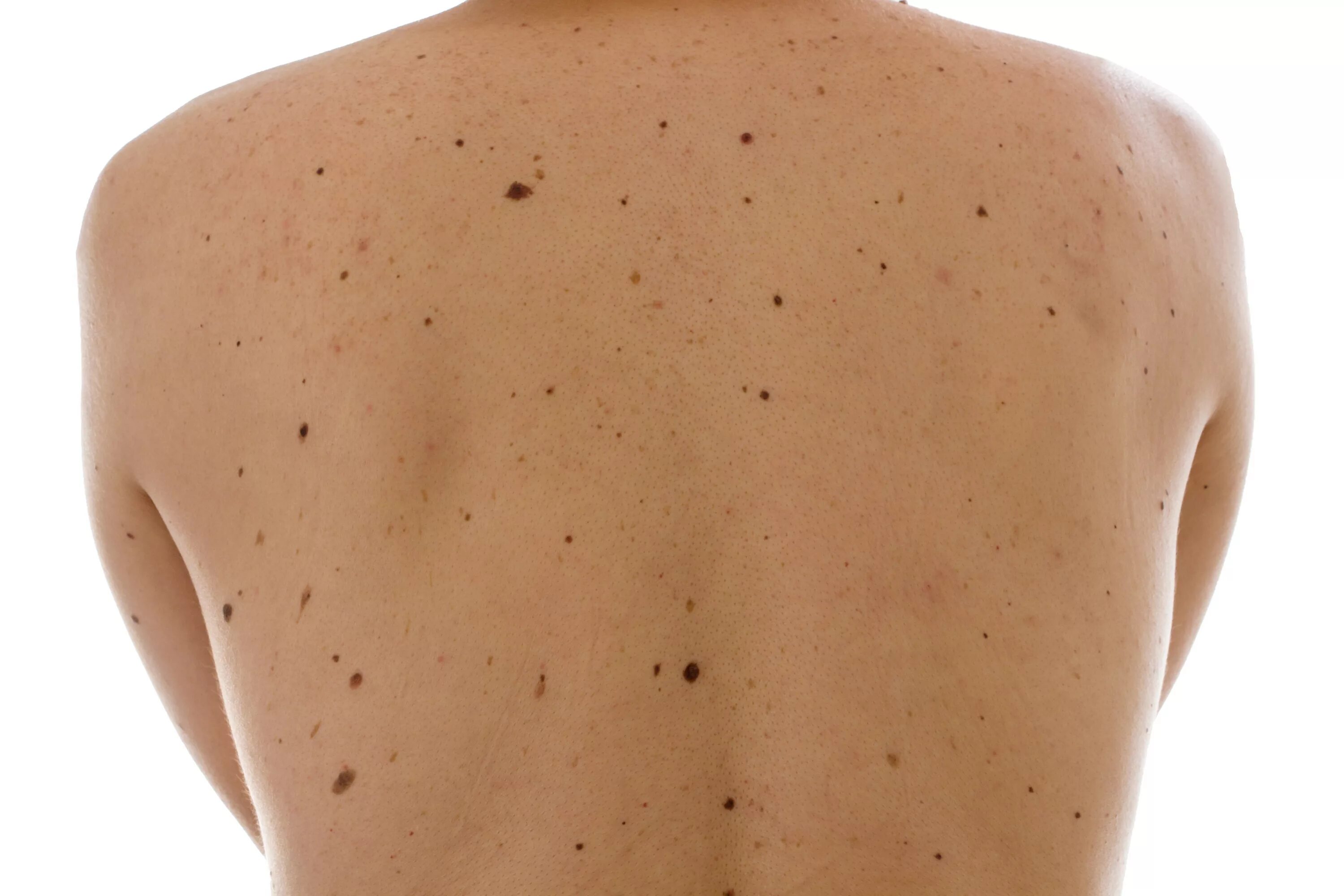 Прыщи от солнца на спине фото Numbers count in the genetics of moles and melanomas - Faculty of Medicine - Uni