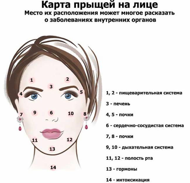 Прыщи схема расположения на лице Прыщи на висках: причины появления