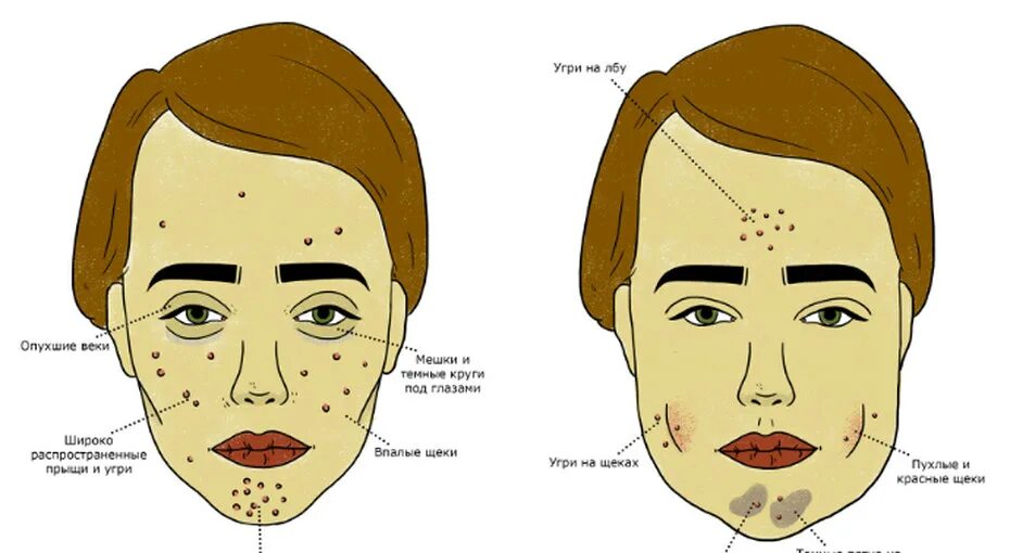 Прыщи схема расположения на лице Прыщи на правой стороне: найдено 89 изображений