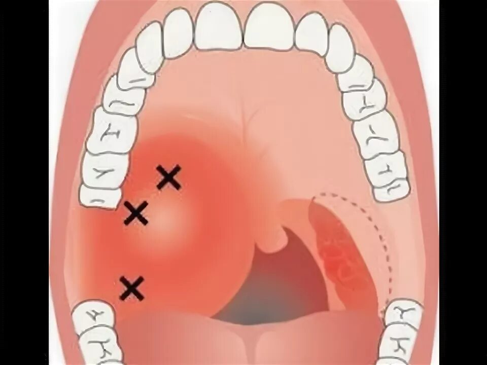 Прыщик на небе фото Quinsy - Peritonsillar Abscess on Endoscopy - YouTube