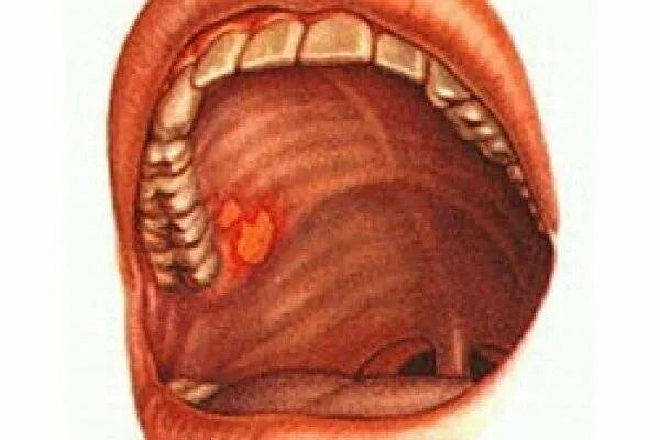 Прыщики на небе во рту фото Картинки на небе красные пятна (69 фото)