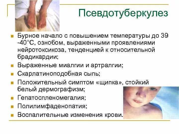 Псевдотуберкулез сыпь фото Псевдотуберкулез у детей: 6 предрасполагающих факторов, 5 групп симптомов, метод