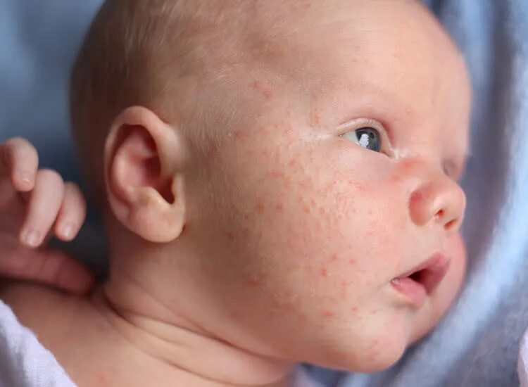 Псевдотуберкулез сыпь фото сыпи у детей Baby Rashes: Types, Symptoms & More