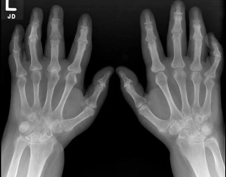 Псориатический артрит симптомы фото Psoriatic Arthritis X Ray Check more at http://www.nhprimecare.org/psoriatic-art