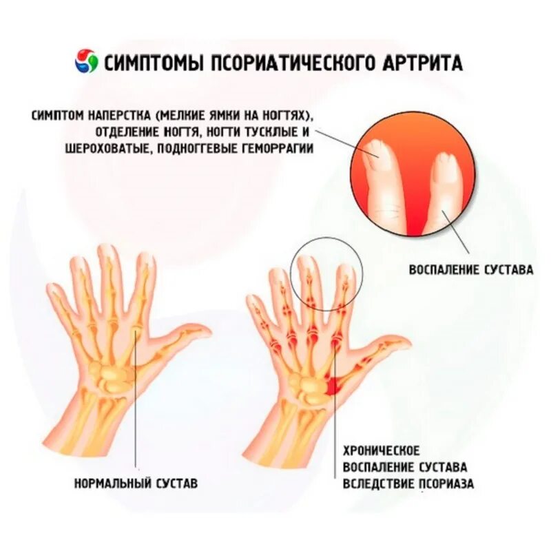 Псориатический артрит симптомы фото и лечение признаки Пальцы рук болит как лечить