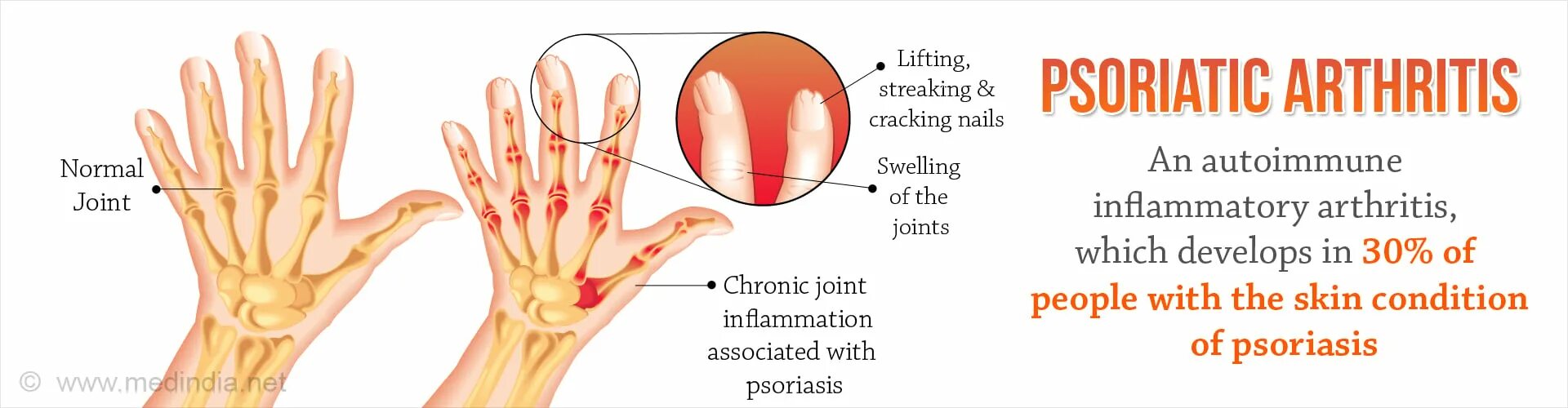 Псориатический артрит симптомы фото и лечение признаки Psoriatic Arthritis - Frequently Asked Questions