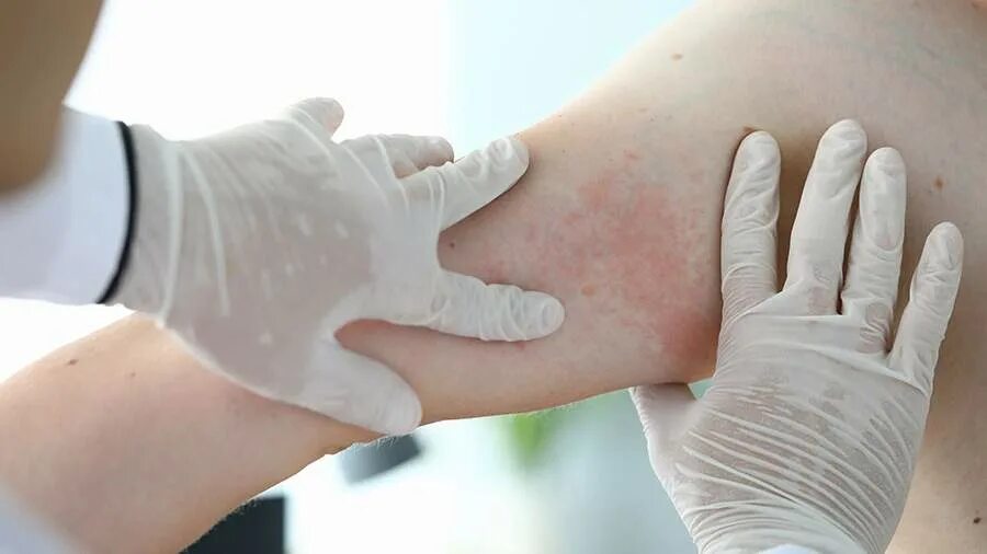 Eczema: Who is Affected and What You Need to Know Sanova Dermatology