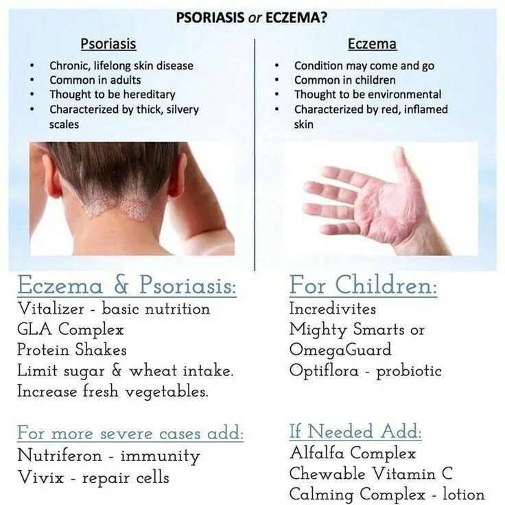 Псориаз экзема дерматит фото These Tips Can Help You Cope With Eczema Find out more at the image link. #Eczem