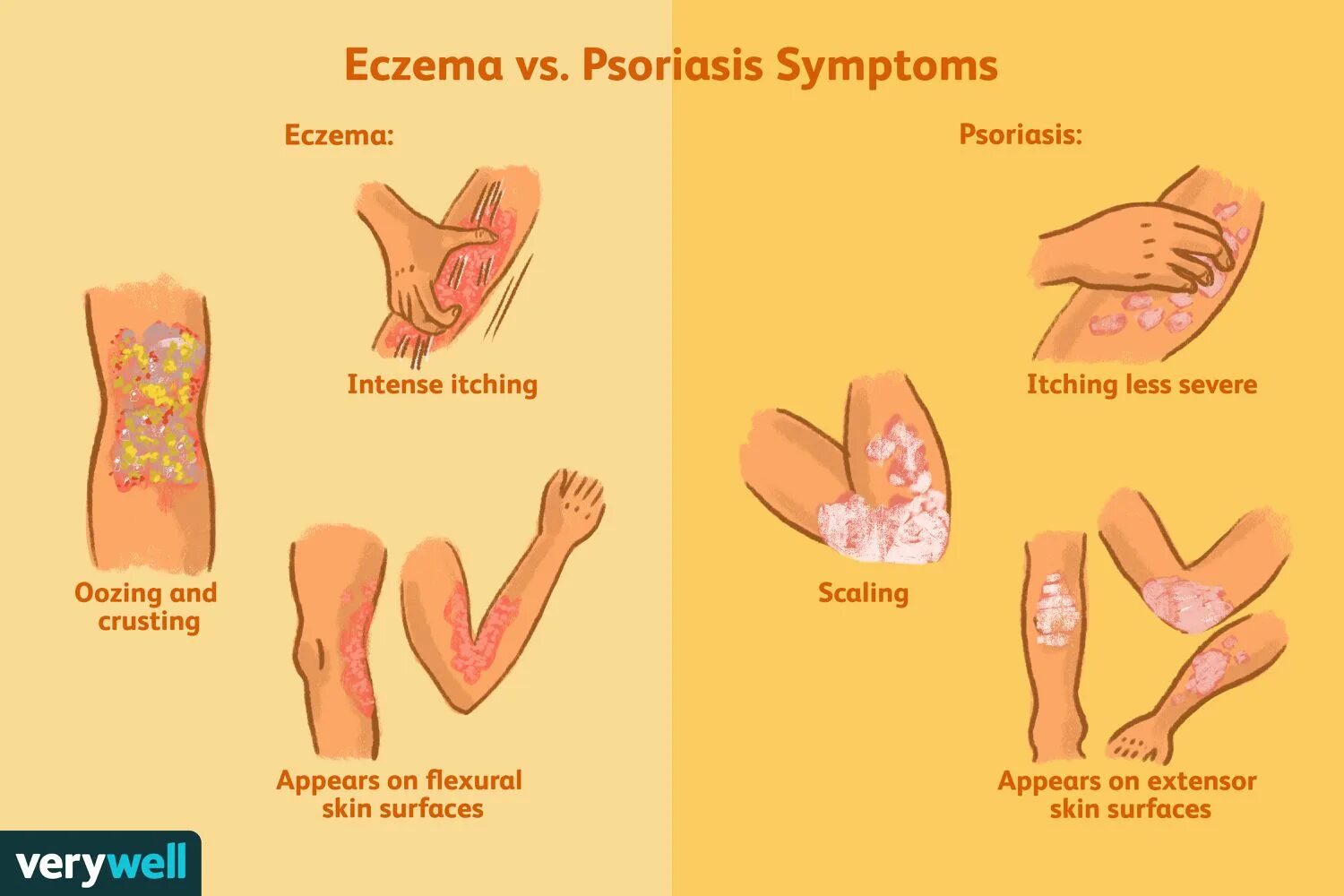 Псориаз экзема дерматит фото Eczema vs. Psoriasis: How to Tell Them Apart