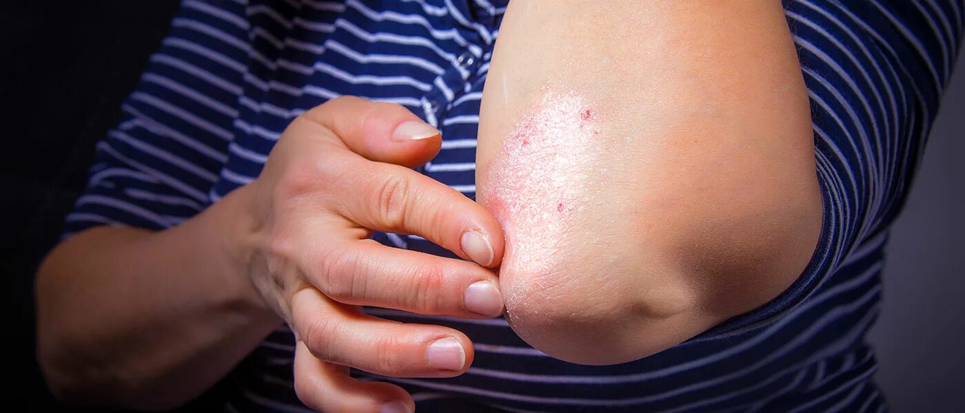 Псориаз фото на коже начальная стадия Dermatology's Neil Korman weighs in on effects of plaque psoriasis