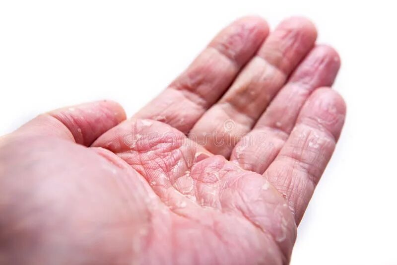 Псориаз фото на руках симптомы и лечение Closeup of Eczema Dermatitis on Back Fingers Stock Image - Image of condition, h