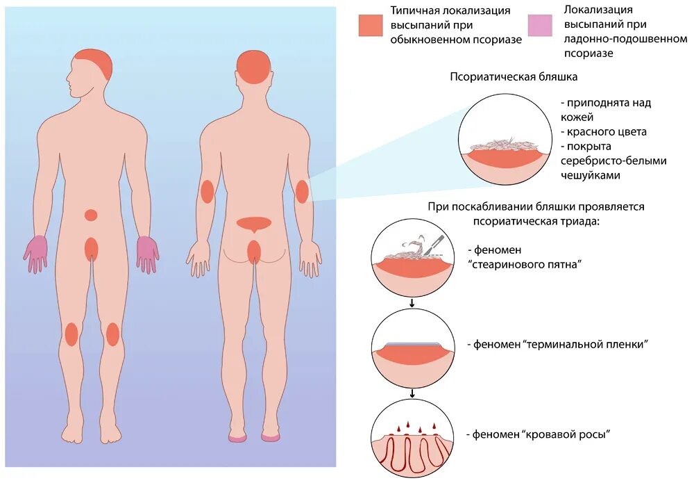 Псориаз фото на теле симптомы и лечение Симптомы мужского климакса: физиологические и психические аспекты