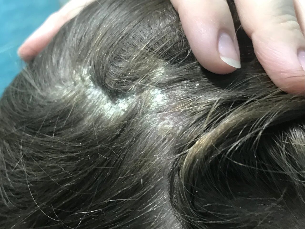 Scalp Psoriasis Зображення - огляд 1,989 Стокові фото, векторні зображення й від