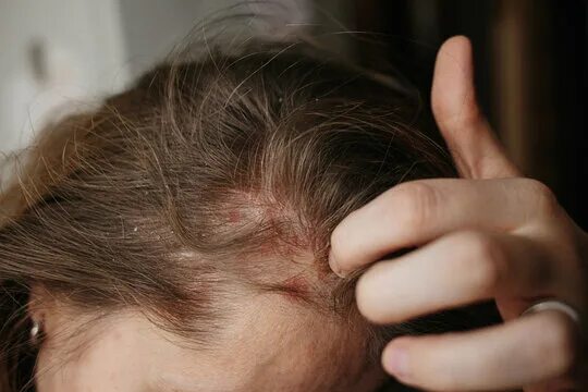 Псориаз фото начальной стадии на голове Scalp Psoriasis Зображення - огляд 1,989 Стокові фото, векторні зображення й від