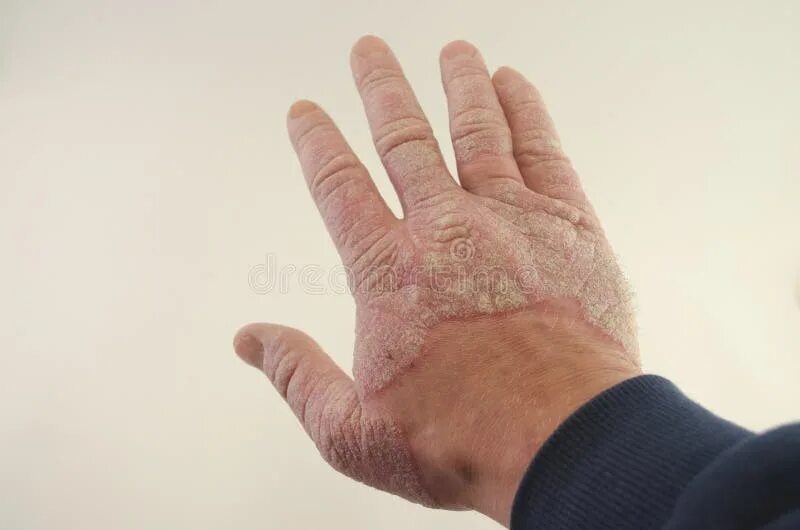 Псориаз фото начальной стадии на руках Exacerbation of Psoriasis in the Hands Stock Image - Image of background, isolat