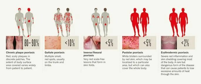 Псориаз фото начальной стадии на теле Pin auf Health