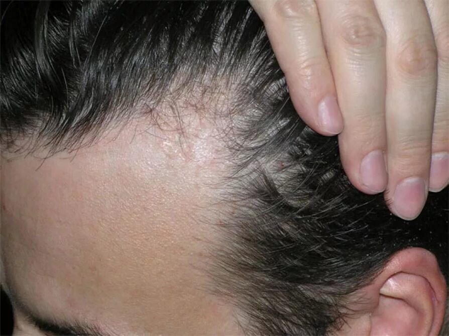 Scalp Psoriasis Зображення - огляд 1,989 Стокові фото, векторні зображення й від