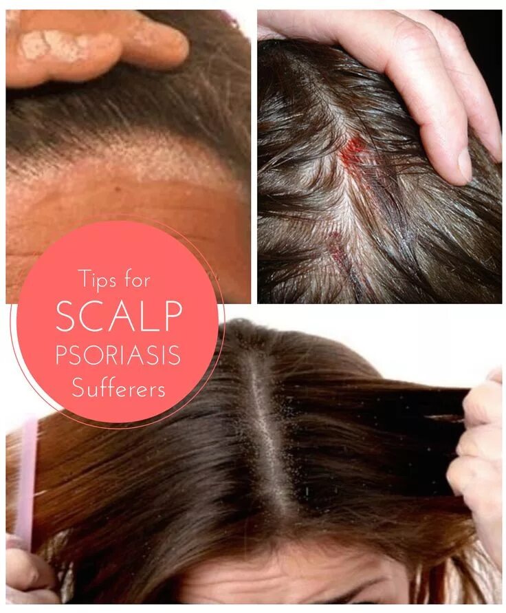 Псориаз головы фото начальная стадия лечение Tips for Finding Effective Relief from the Symptoms of Scalp Psoriasis Cheveux, 