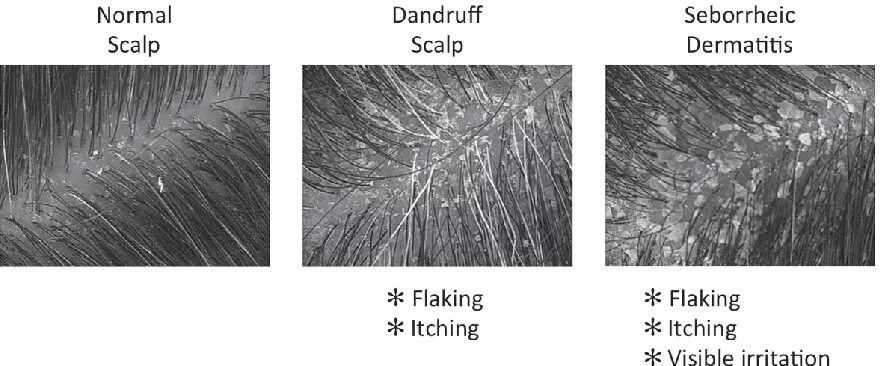 Псориаз и себорейный дерматит отличия фото Figure 1 from Dandruff and Seborrheic Dermatitis : A Head Scratcher Semantic Sch