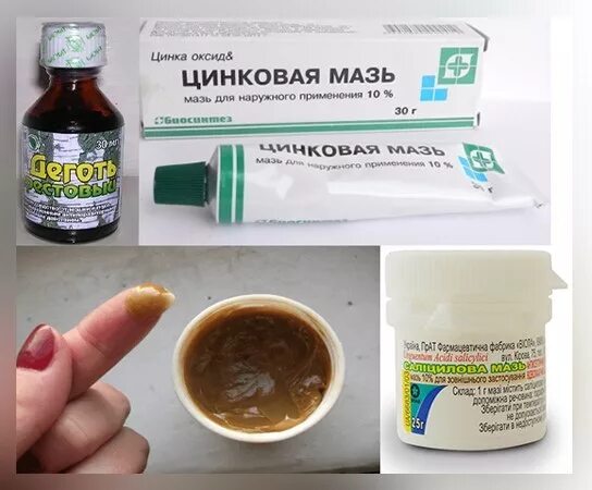 Псориаз лечение мази и таблетки фото Juckreiz bei Psoriasis: wie entfernen, loswerden? Wirksame Heilmittel