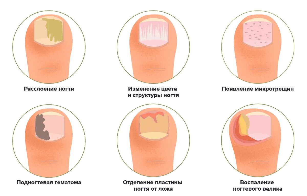 Псориаз на ногтях фото начальная стадия Посмотрите на свои ногти: вот что можно по их изменениям сказать о вашем здоровь