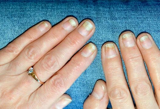 Псориаз ногтей фото Nail Disease Зображення - огляд 24,160 Стокові фото, векторні зображення й відео