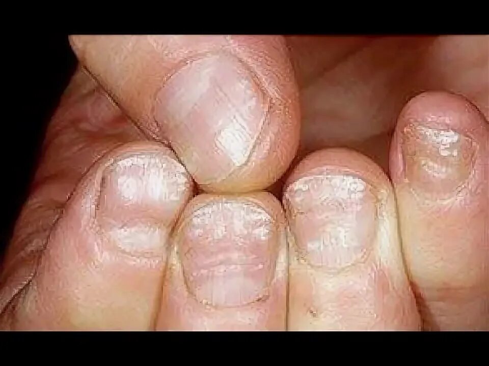 Псориаз ногтей фото на руках White Stains or White Marks on your Toenails? Home Treatment Guide - YouTube