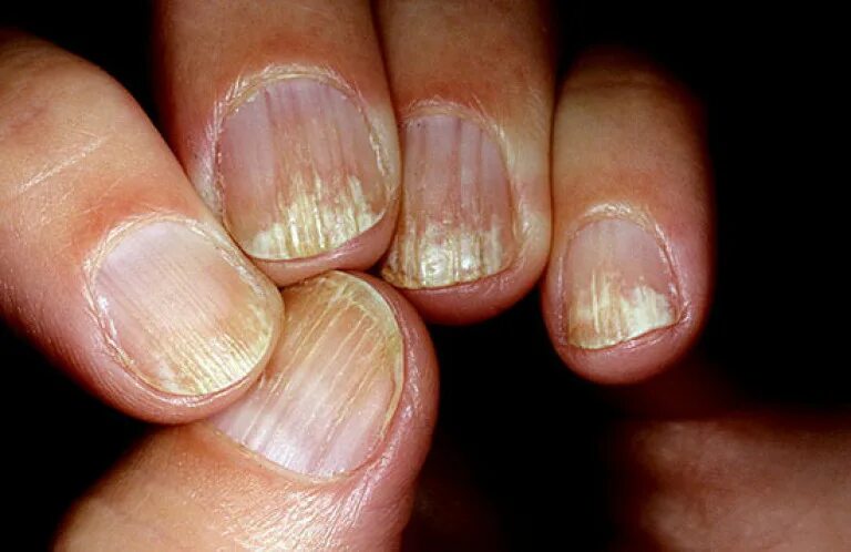 Псориаз ногтей фото на руках Onychodystrophy. Changing the shape of nails. Photo.