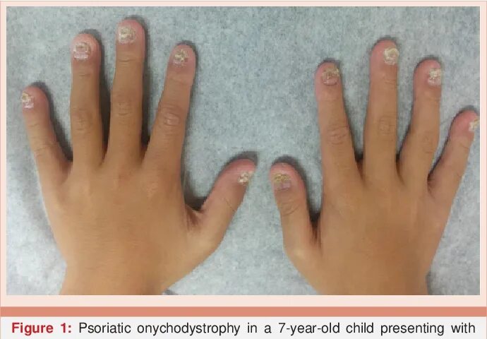 Псориаз ногтей фото на руках PDF Psoriasis with Onychodystrophy in a 7-Year-Old Boy Semantic Scholar