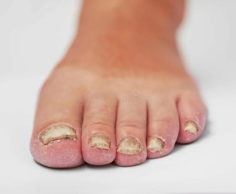 Псориаз ногтей на ногах фото Fungal Disease. Fungoid disease of a nail , #Sponsored, #Disease, #Fungal, #Fung