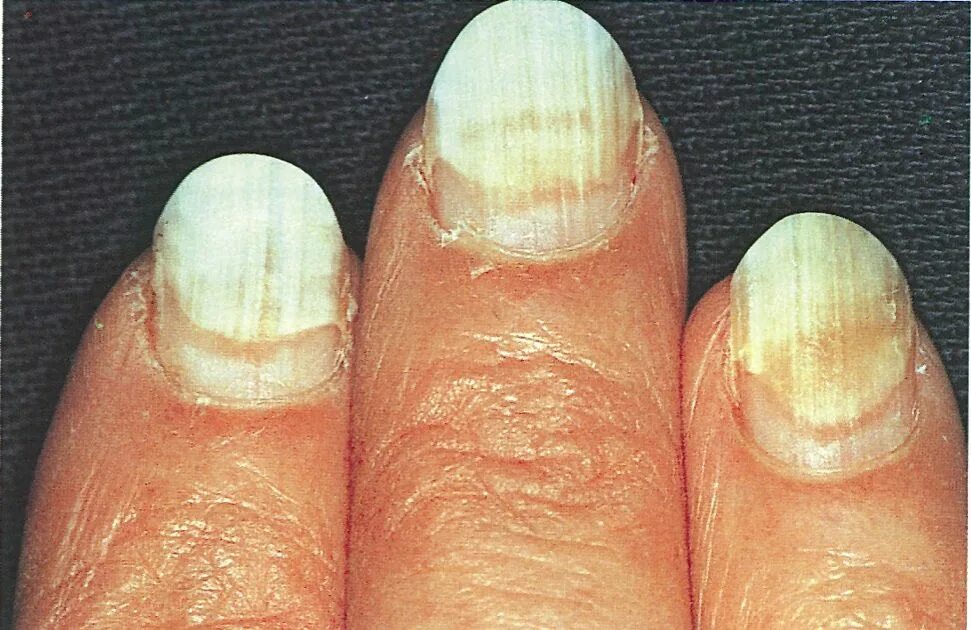 Псориаз ногтей на ногах фото лечение Nail Separation Anxiety - Wellness - NAILS Magazine