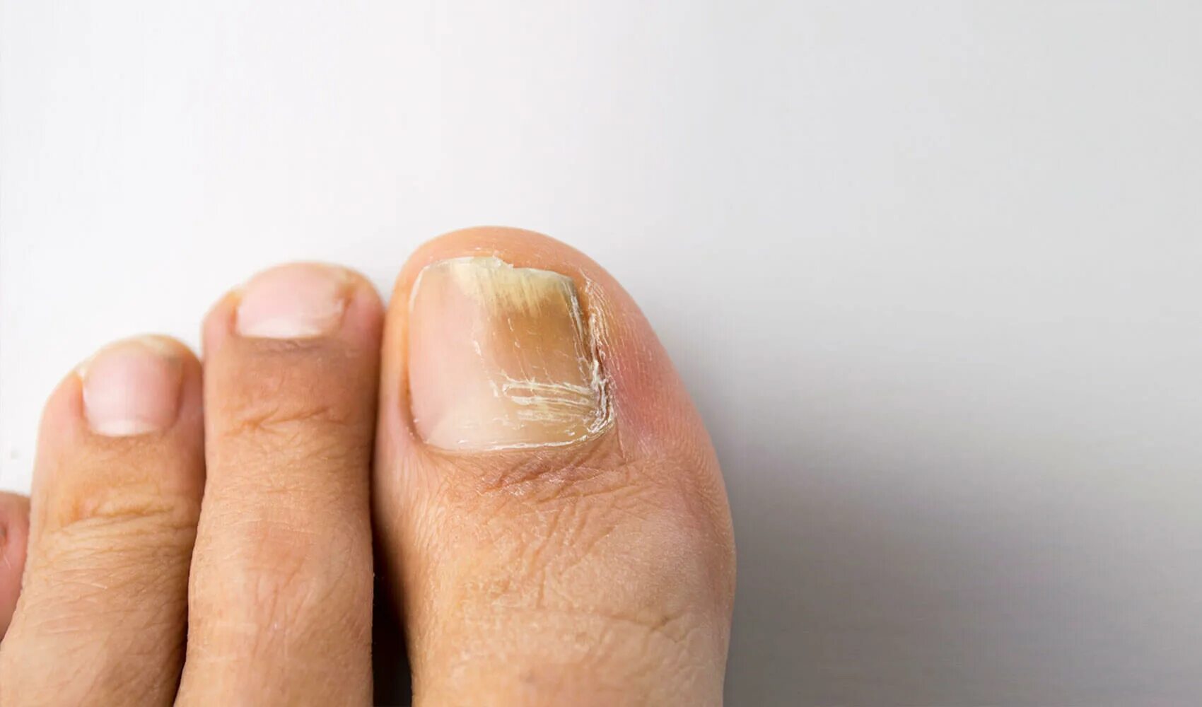 Fungal Disease. Fungoid disease of a nail , #Sponsored, #Disease, #Fungal, #Fung