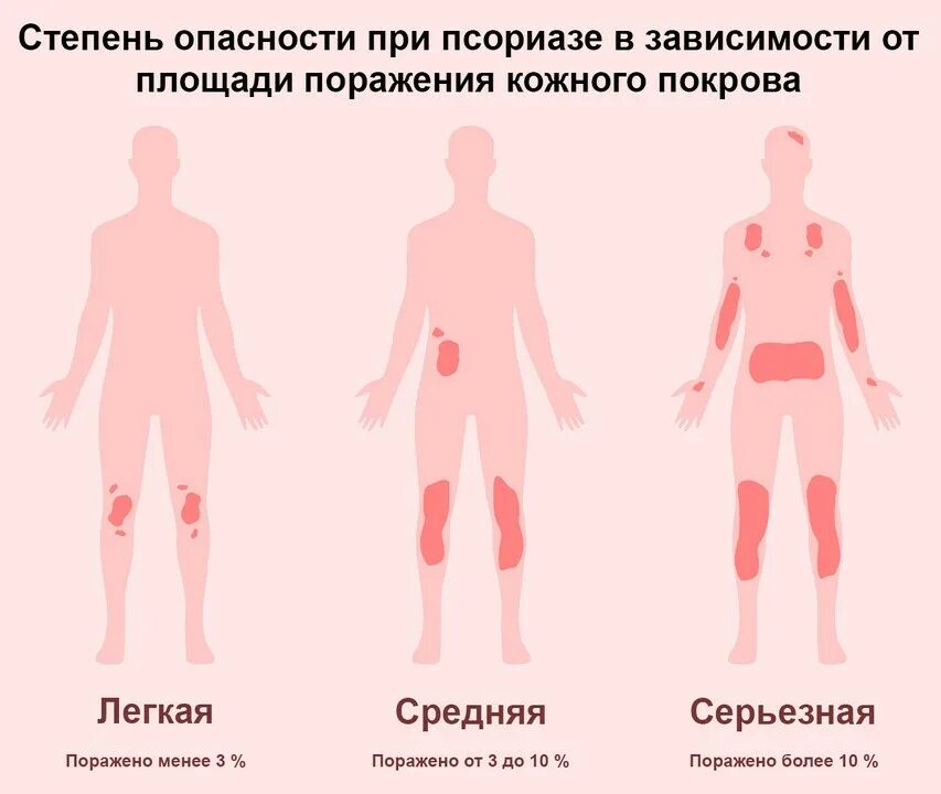 Псориаз симптомы и признаки фото Псориаз