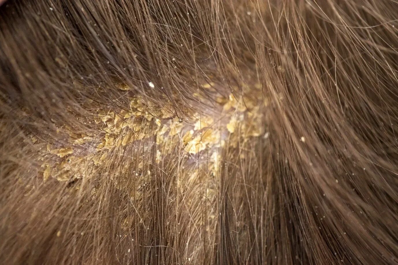 Псориаз волосистой части головы фото начальная стадия What is Yellow Dandruff and Why is it so? Head & Shoulders IN