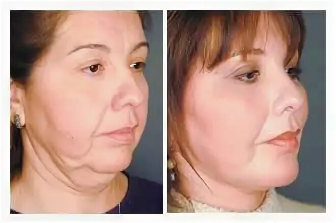 Птоз лица фото Facelifting - Plastische Chirurgie Vorher und Nachher - #Gesicht #Lift #Kunststo