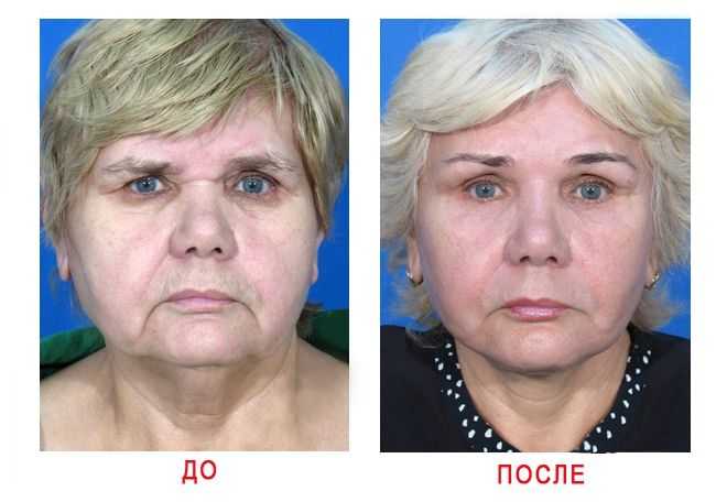 Птоз лица фото после 40 лет Птоз лица после 40 лет - Olphoto.ru