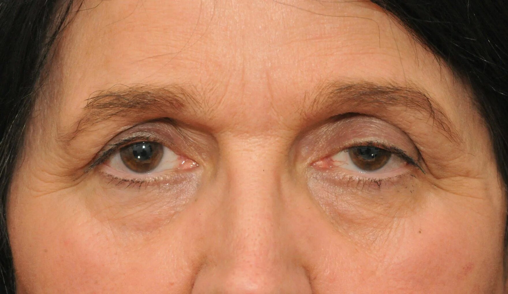 Птоз нижнего века фото How To Treat Droopy Eyes Naturally and Effectively Droopy eyes, Droopy eyelids, 