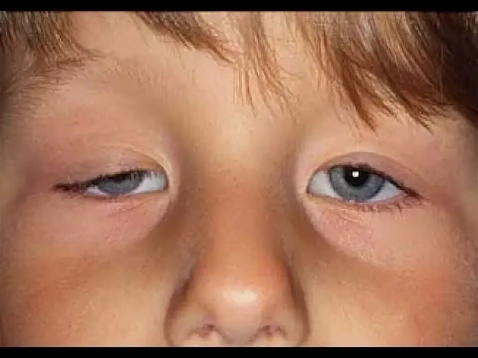 Птоз верхнего века фото детей Cas clinique corrigé en Ophtalmologie : Ptosis chez l'enfant - YouTube