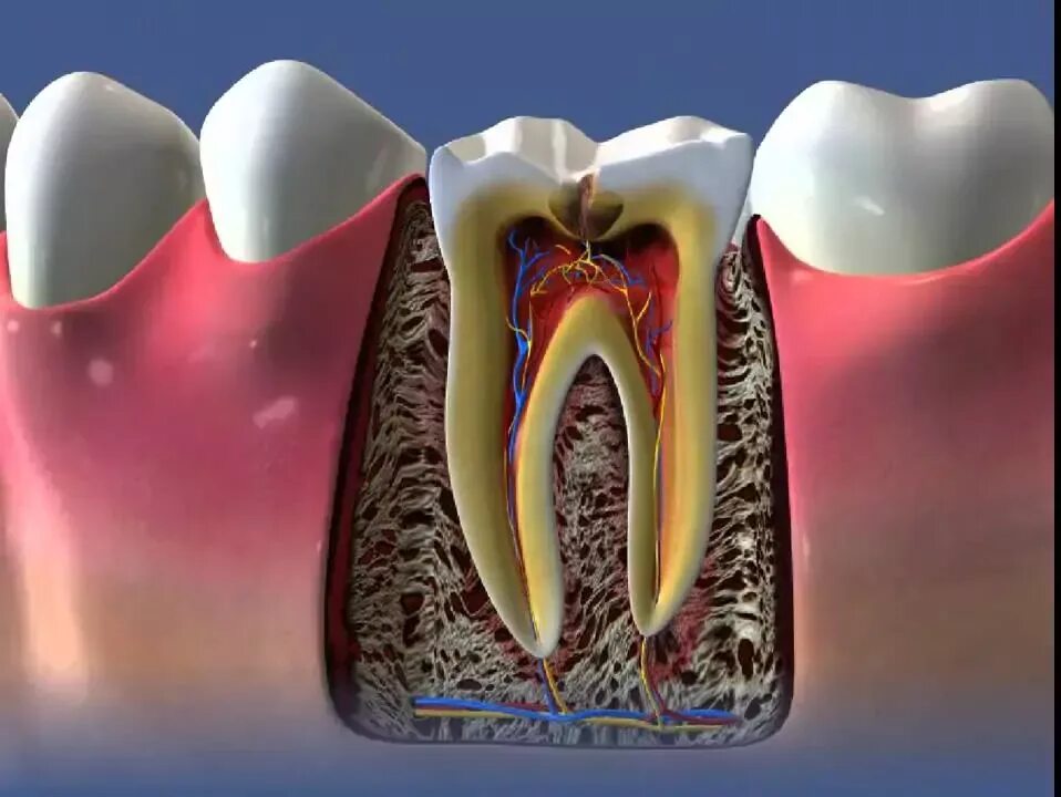 Пульпа зуба фото Развитие кариозного поражения - Стоматология Локис