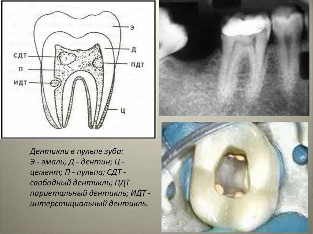 Пульпа зуба фото Патология твердых тканей зуба, пульпы и периапикальных тканей зуба. Болезни паро