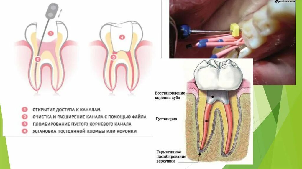 Пульпа зуба фото Заболевания пульпы зуба. Часть I - презентация онлайн
