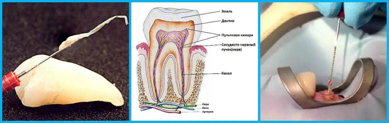 Пульпа зуба фото Удаление нерва болит