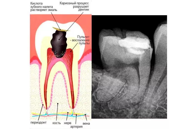 Пульпит как выглядит фото на зубе живое Фиброзный пульпит: причины, симптомы, диагностика и лечение