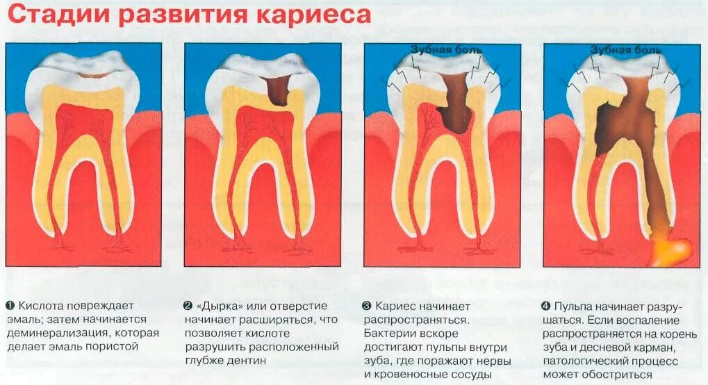 Пульпит как выглядит фото на зубе живое Лечение кариеса Стоматология "Дента-Мед"