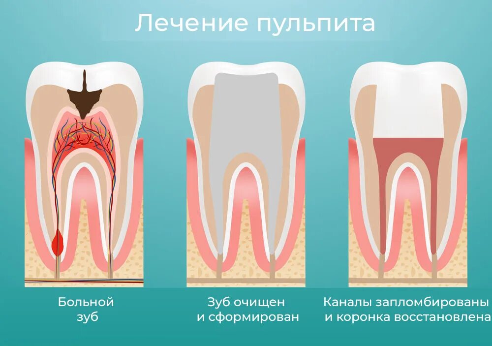 Пульпит молочного зуба фото Лечение пульпита зуба в Одинцово - стоимость, этапы, методы