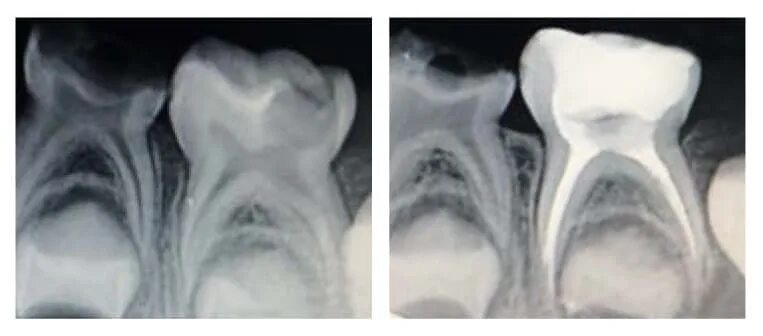 Пульпит молочного зуба фото Лечение пульпита у детей