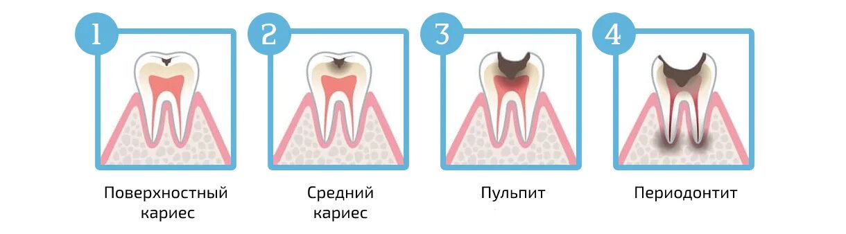 Пульпит молочного зуба фото Лечение пульпита молочных зубов у детей в Москве - Стоимость услуги по акции на 