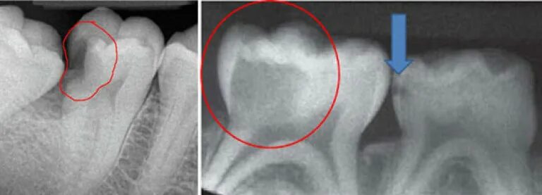 Пульпит молочного зуба фото Pulpitis is acute and chronic. Symptoms Diagnostics. Treatment. Photo.