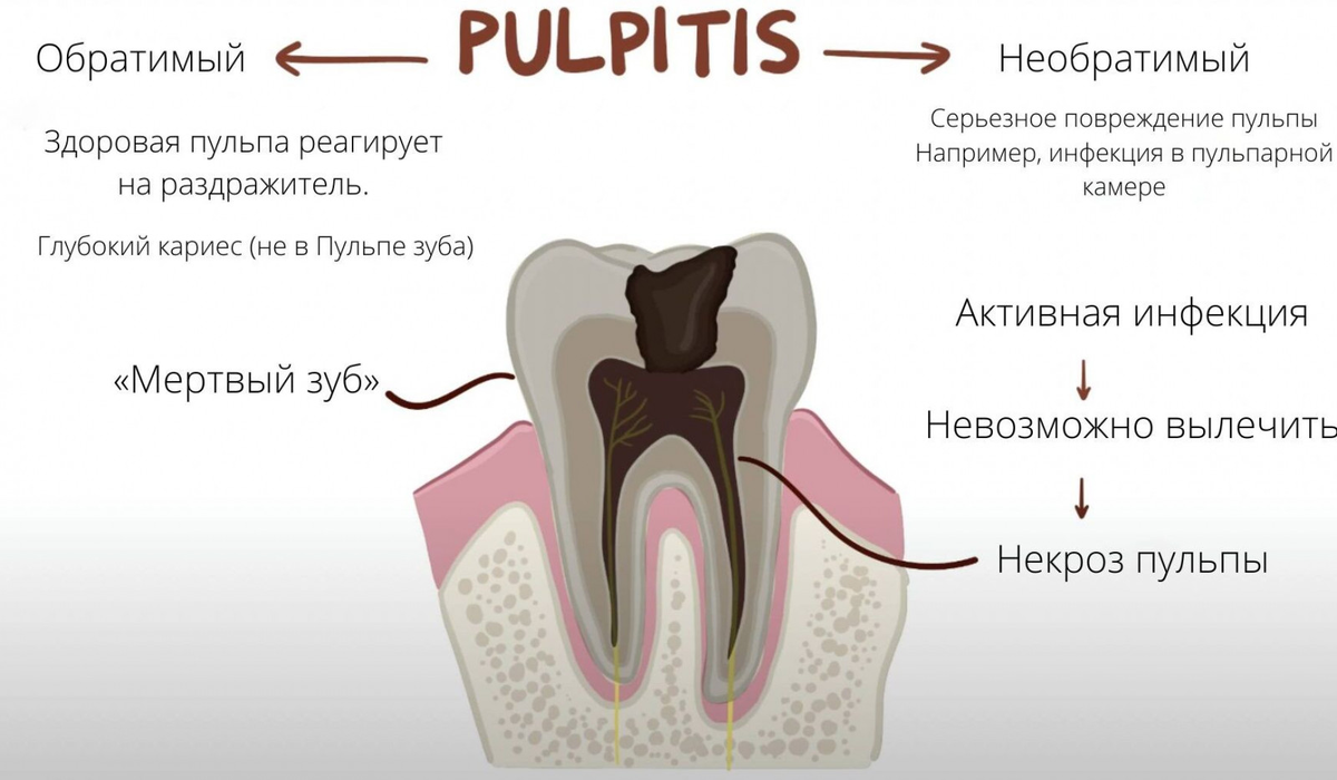 Пульпит молочного зуба фото Зуб болит, НО он ЗДОРОВ Записки юного врача Дзен