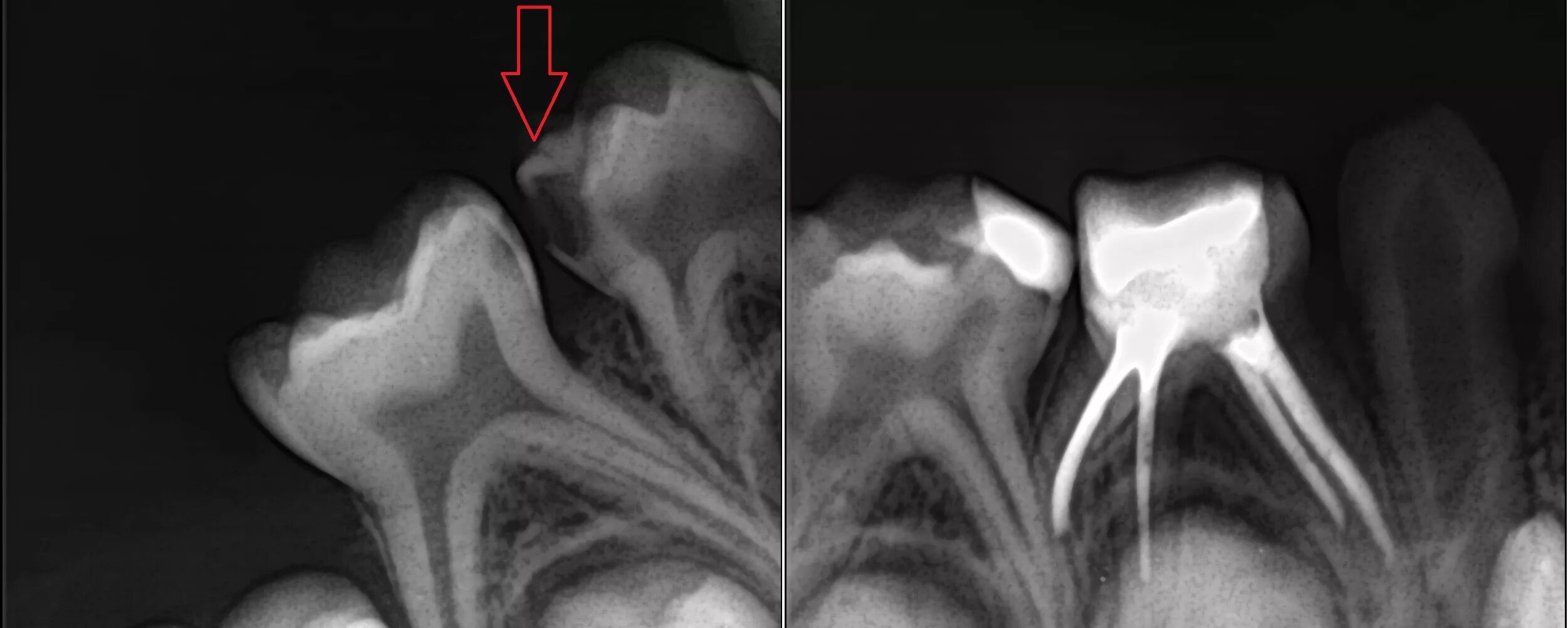 Пульпит молочного зуба фото Кариес на снимке: найдено 80 изображений